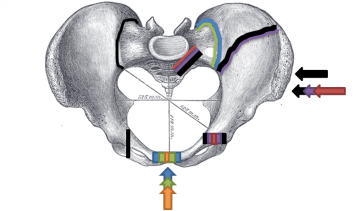Pelvis fracture